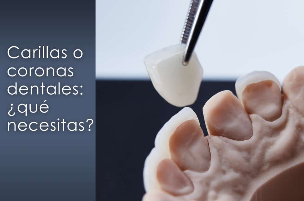 carillas o coronas dentales
