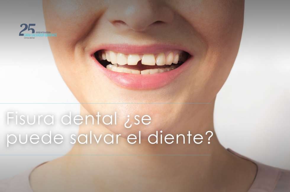 fisura dental